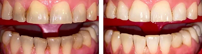 before & after photo of Teeth Whitening