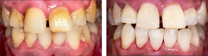 before & after photo of Teeth Whitening