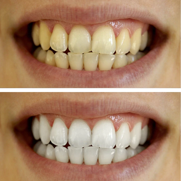 before & after photo of Teeth Whitening