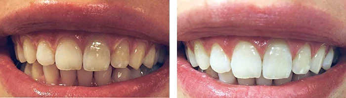 before & after photo of Teeth Whitening