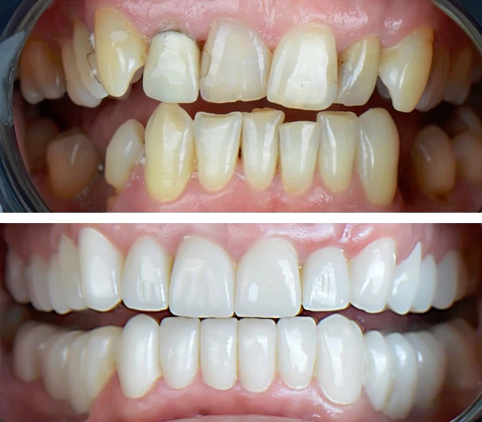 before & after photo of Dental Crown