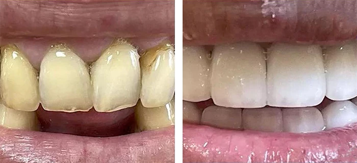 before & after photo of تيجان الأسنان