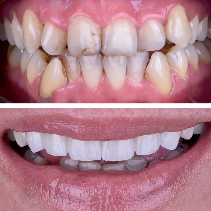 before & after photo of Dental Crown