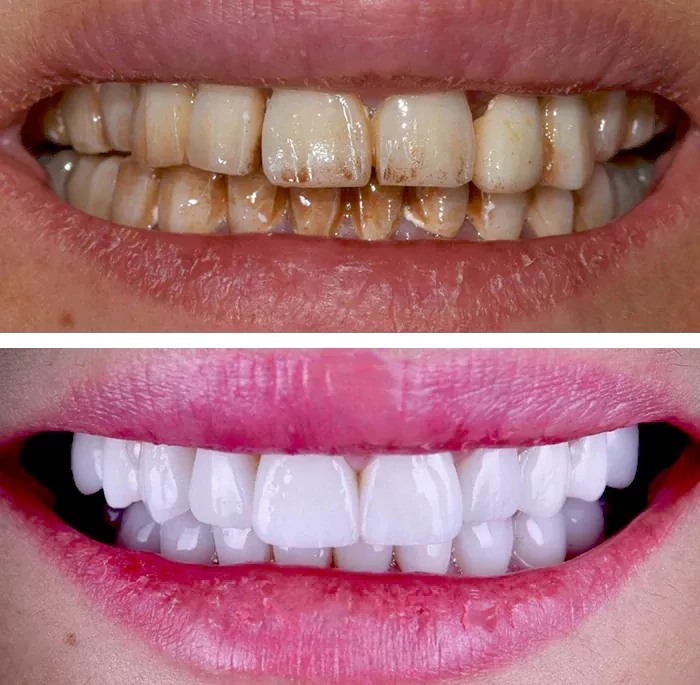 before & after photo of Dental Crown