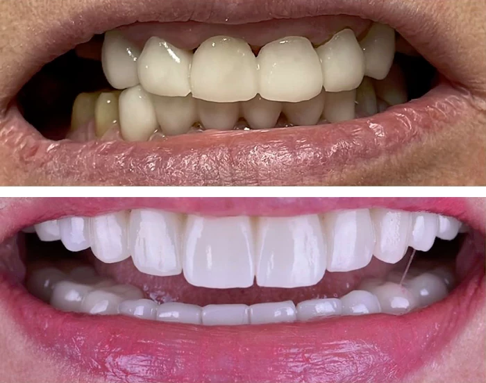 before & after photo of Dental Crown