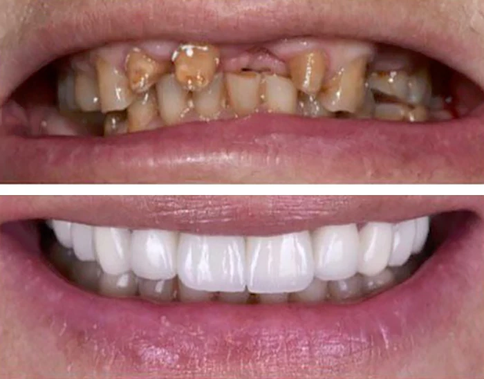 before & after photo of Dental Crown