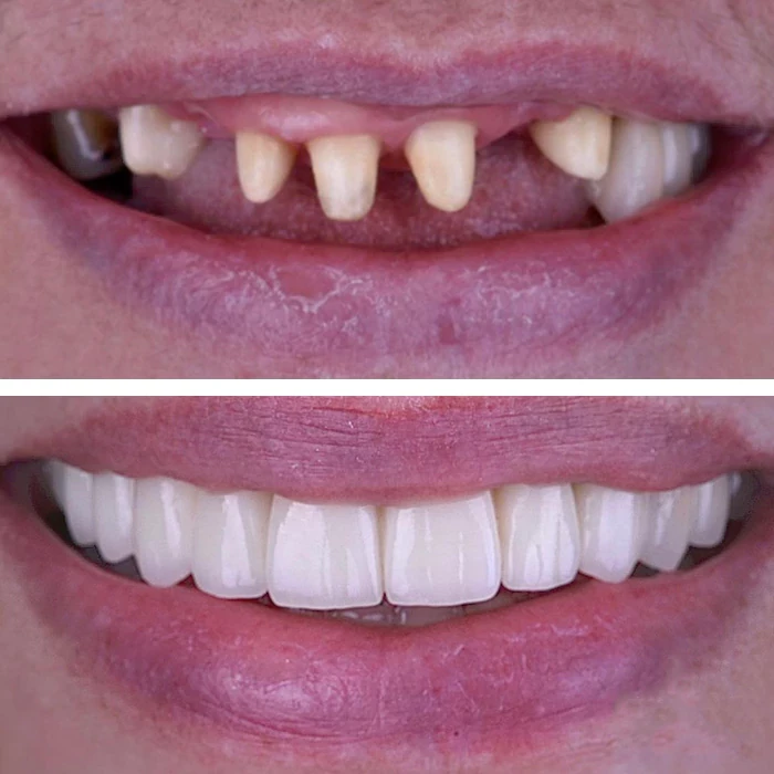 before & after photo of Dental Crown