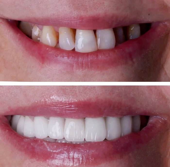 before & after photo of Dental Crown