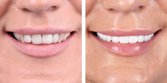 before & after photo of Dental Crown