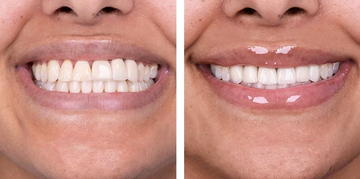 before & after photo of Dental Crown