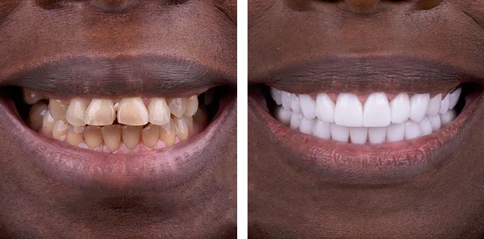 before & after photo of Dental Crown