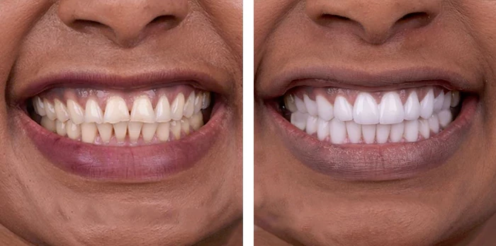 before & after photo of Dental Crown