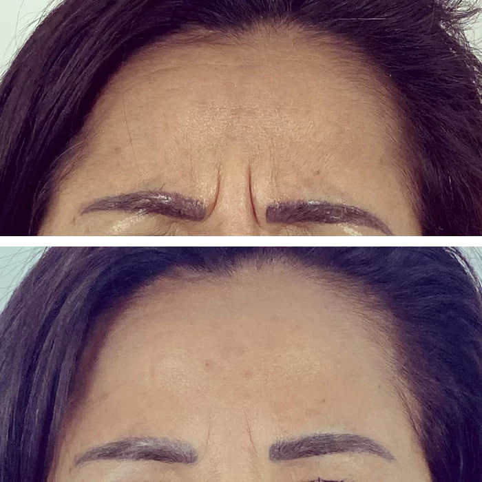 before & after photo of Botox & other Injectable Toxins