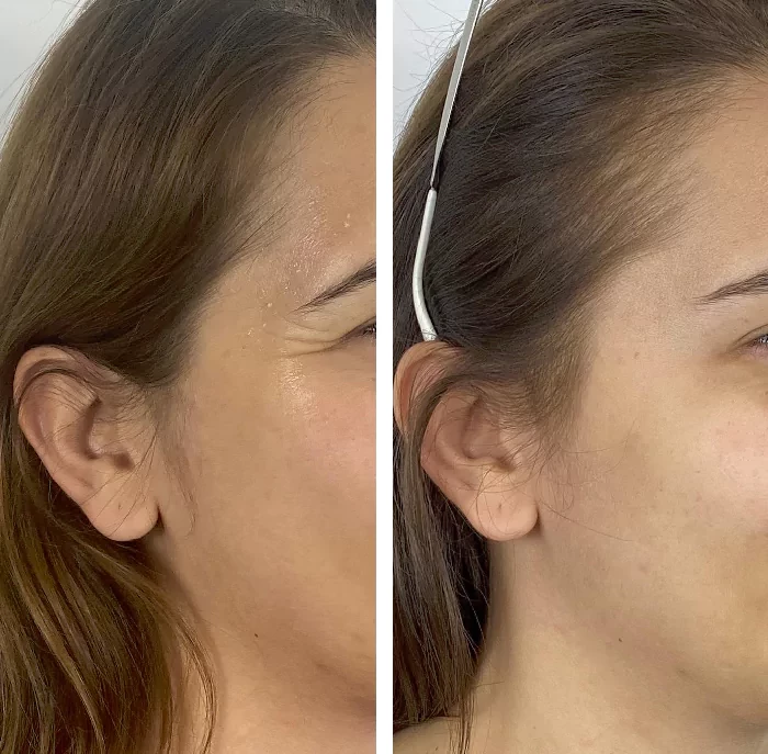 before & after photo of Botox & other Injectable Toxins