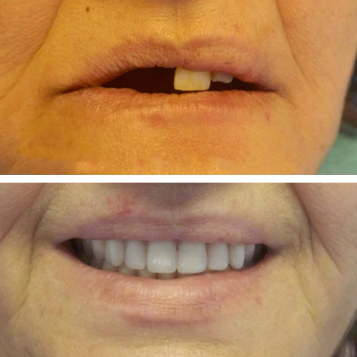 before & after photo of Dental Implant