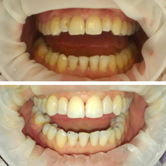 before & after photo of Dental Implant