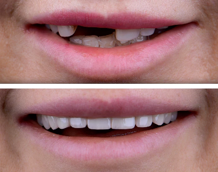 before & after photo of Dental Implant