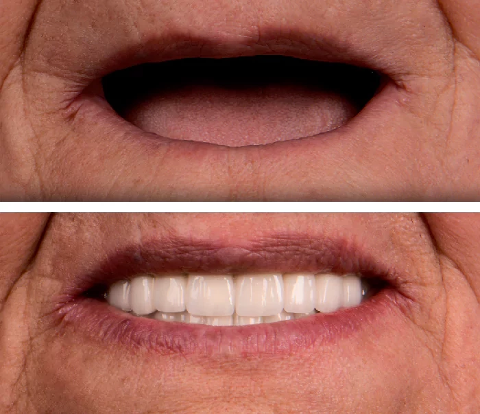 before & after photo of Dental Implant