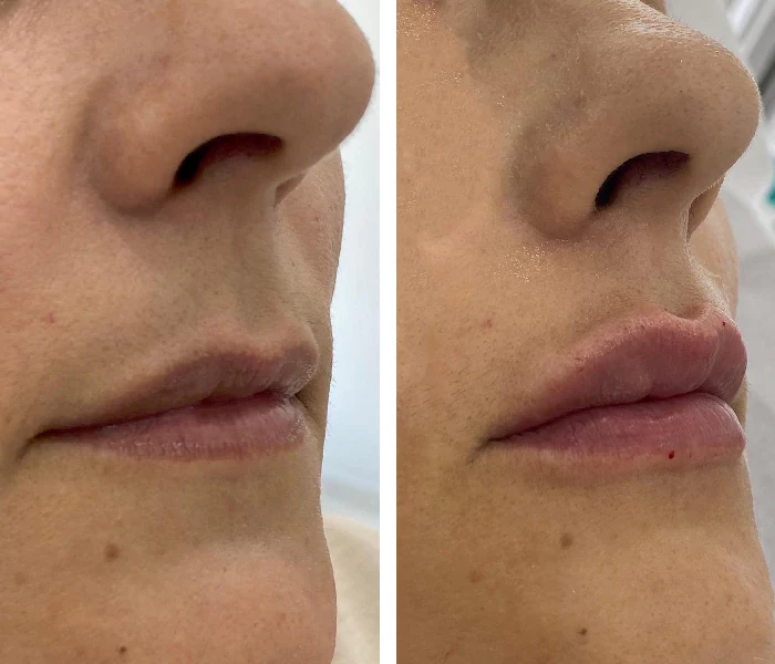 before & after photo of Lip Filler