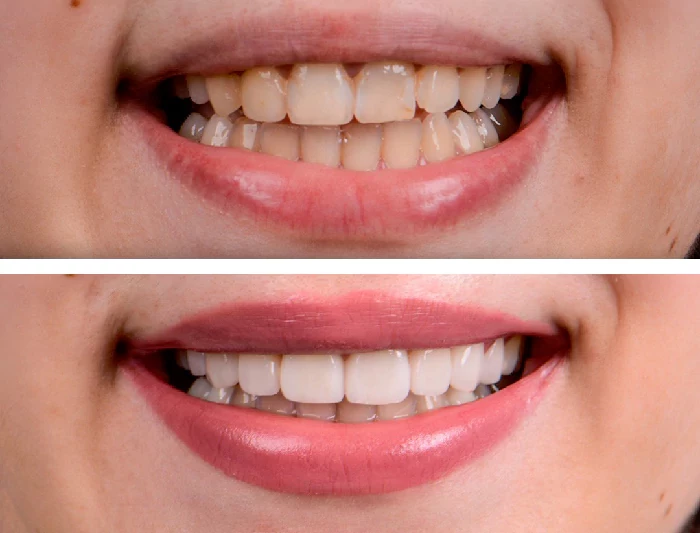 before & after photo of Teeth Whitening