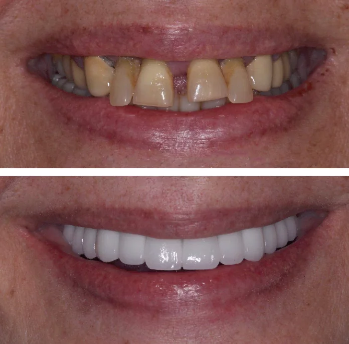 before & after photo of Dental Implant