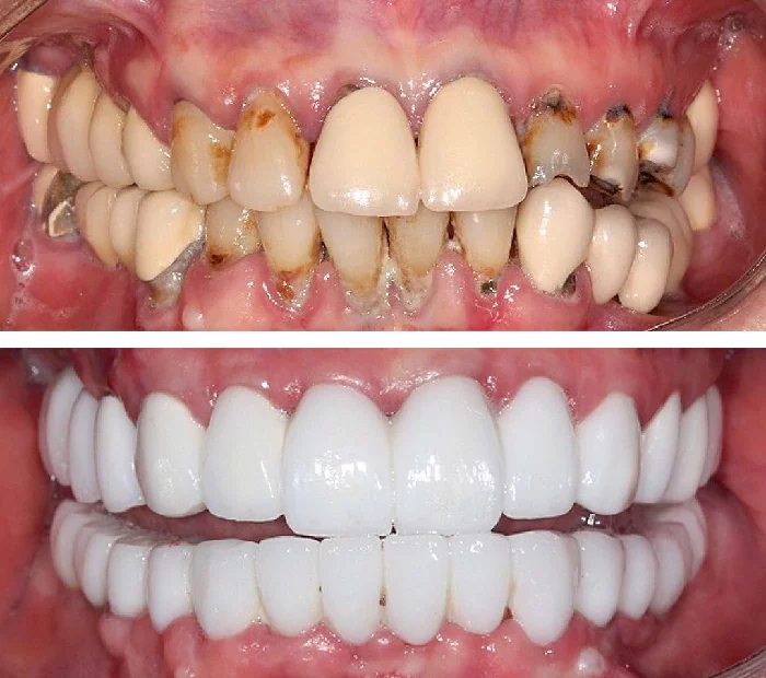 before & after photo of Dental Implant