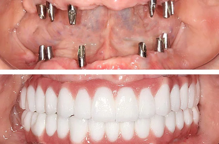 before & after photo of Dental Implant