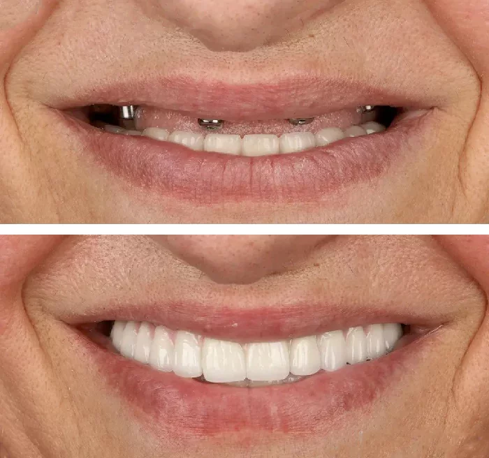 before & after photo of Dental Implant