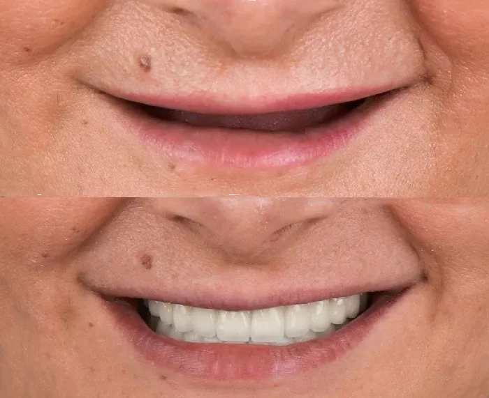 before & after photo of Dental Implant