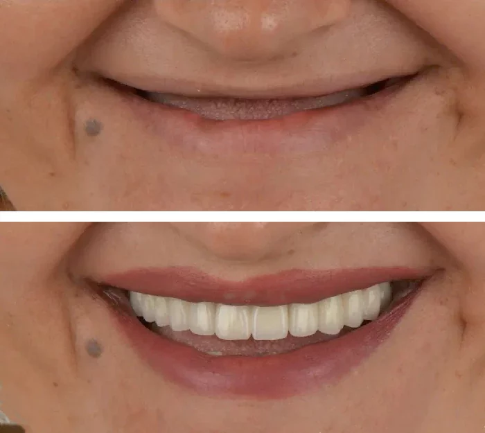 before & after photo of Dental Implant