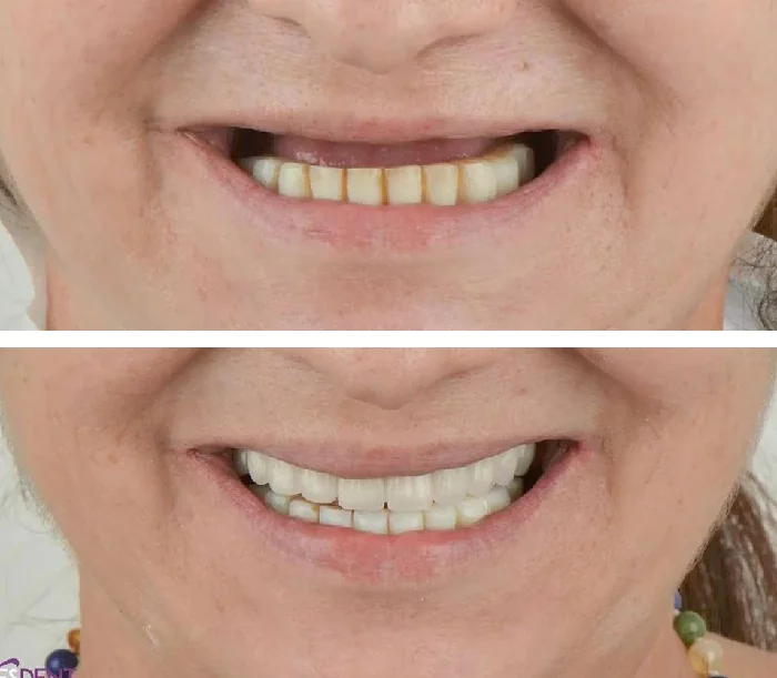 before & after photo of Dental Implant