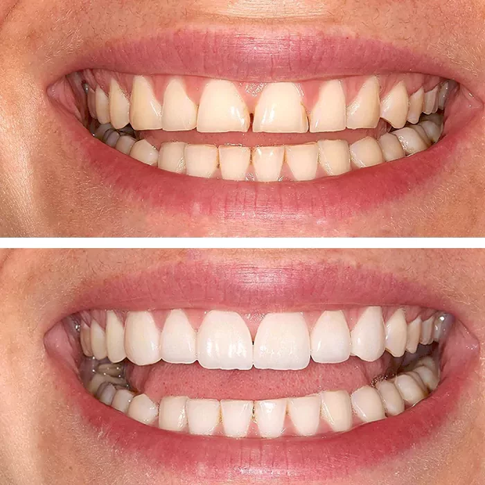 before & after photo of Teeth Whitening