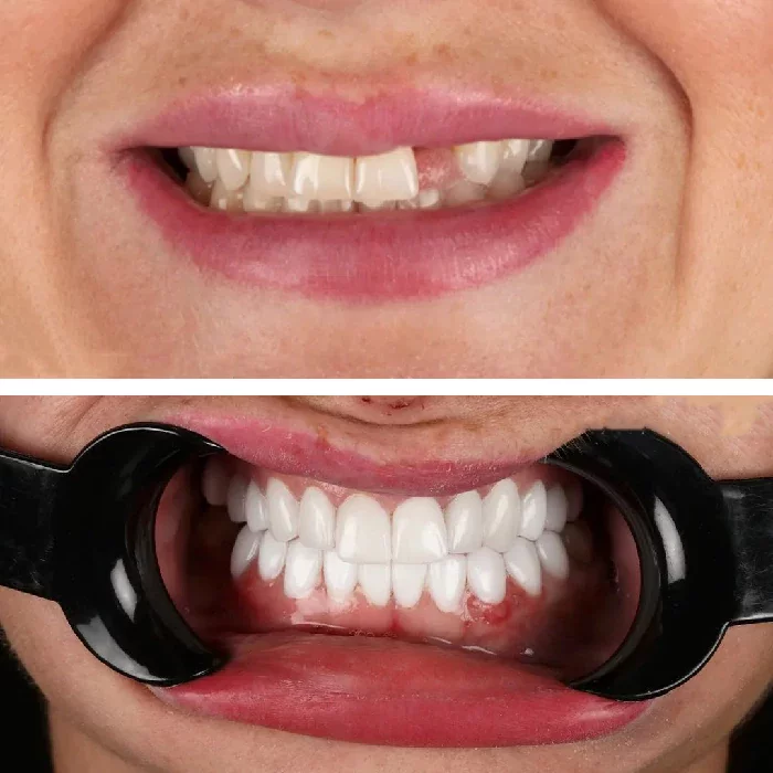 before & after photo of Dental Veneers