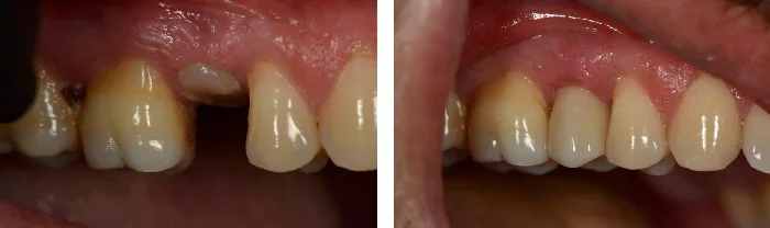 before & after photo of تيجان الأسنان