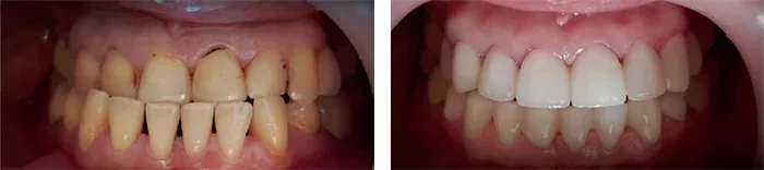 before & after photo of Dental Bridge