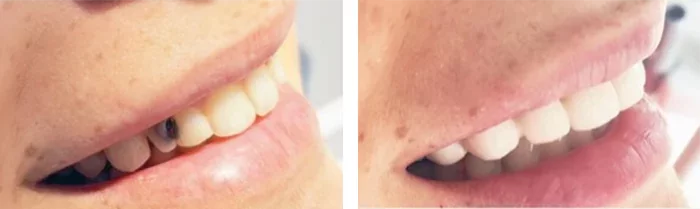 before & after photo of Dental Bridge