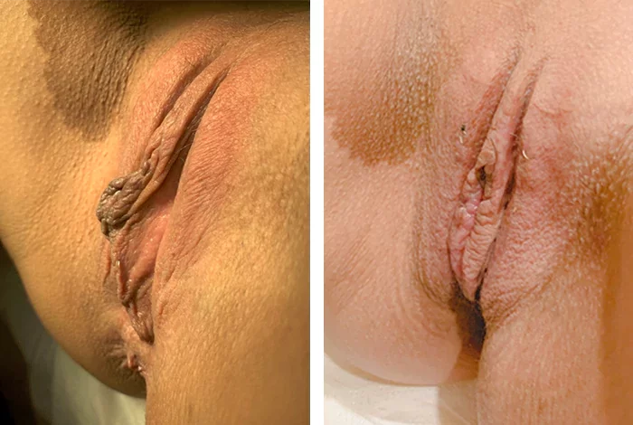 before & after photo of تجميل المهبل