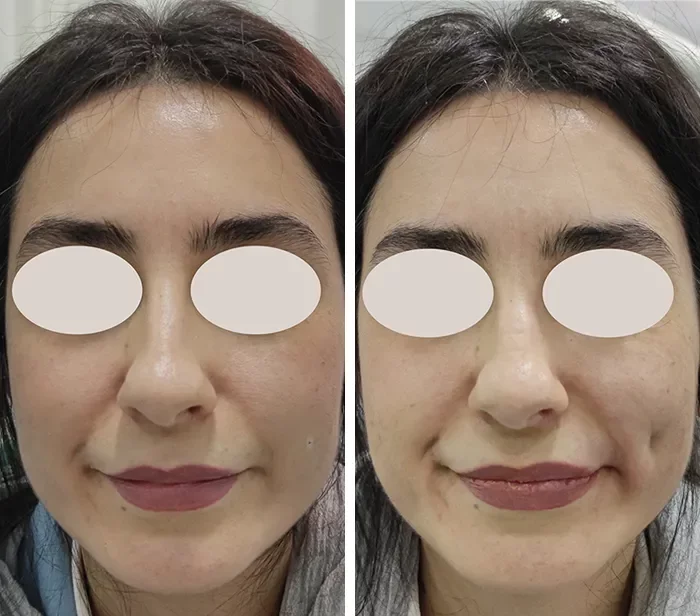 before & after photo of Facial Fat Transfer