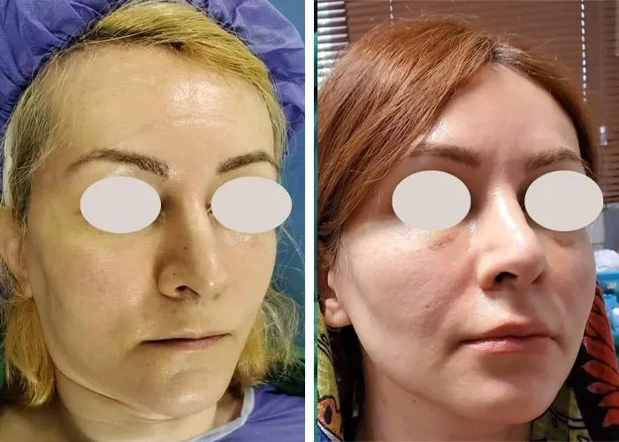 before & after photo of Facial Fat Transfer