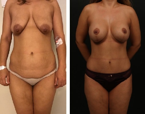 before & after photo of liposuction