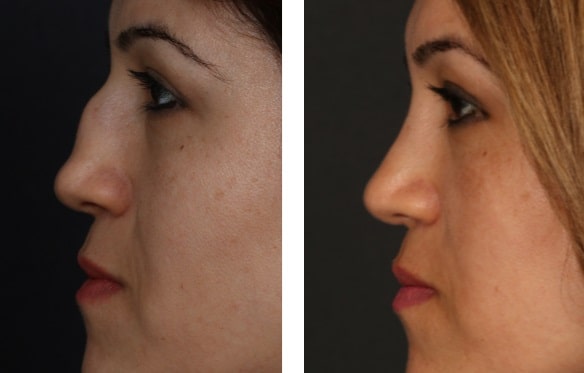 before & after photo of Revision Rhinoplasty