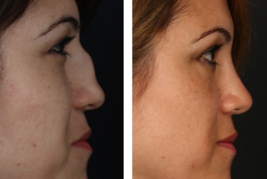 before & after photo of Revision Rhinoplasty