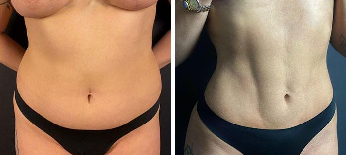 before & after photo of abdominal-etching