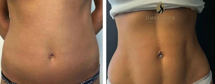 before & after photo of Abdominal Etching