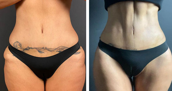 before & after photo of abdominal-etching