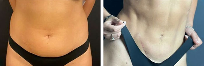 before & after photo of Abdominal Etching