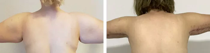 before & after photo of Arm Lift