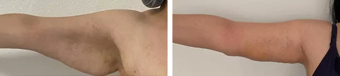 before & after photo of Arm Lift