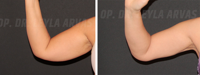 before & after photo of Arm Lift