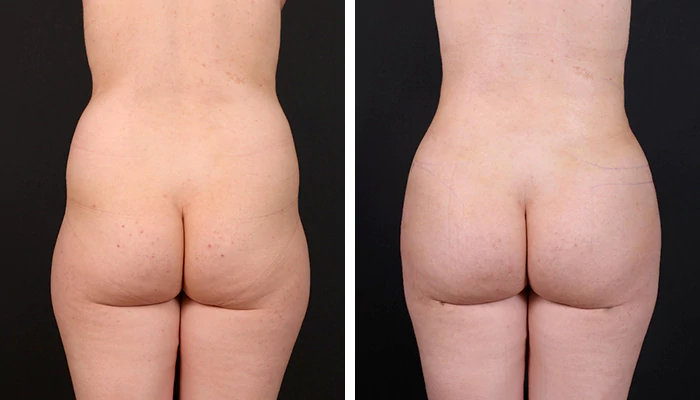 before & after photo of brazilian-butt-lift